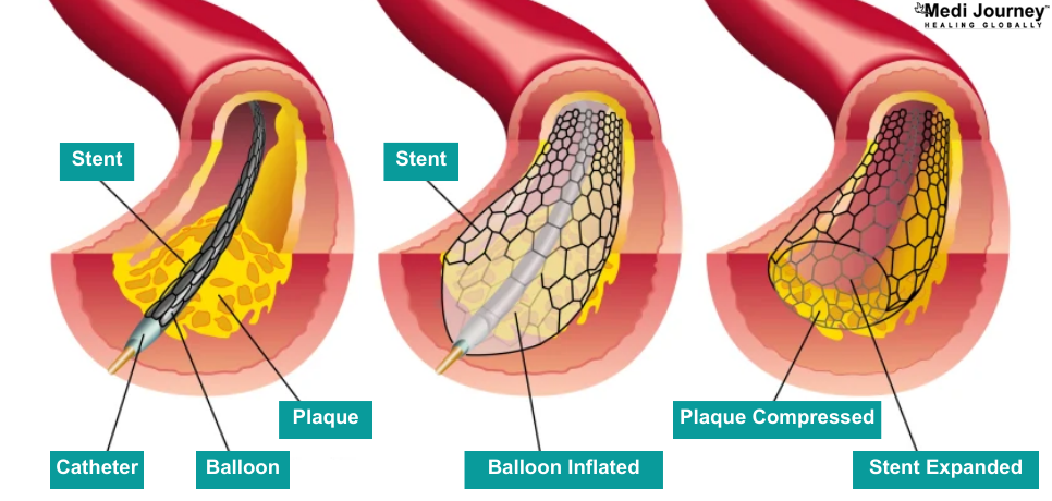 Angioplasty with Stent Placement: How it Helps Open Blocked Arteries