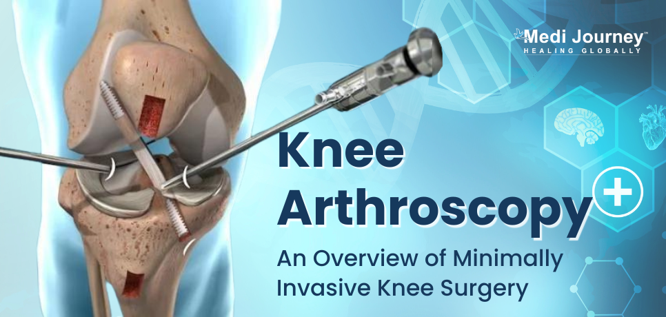 Knee Arthroscopy: An Overview of Minimally Invasive Knee Surgery