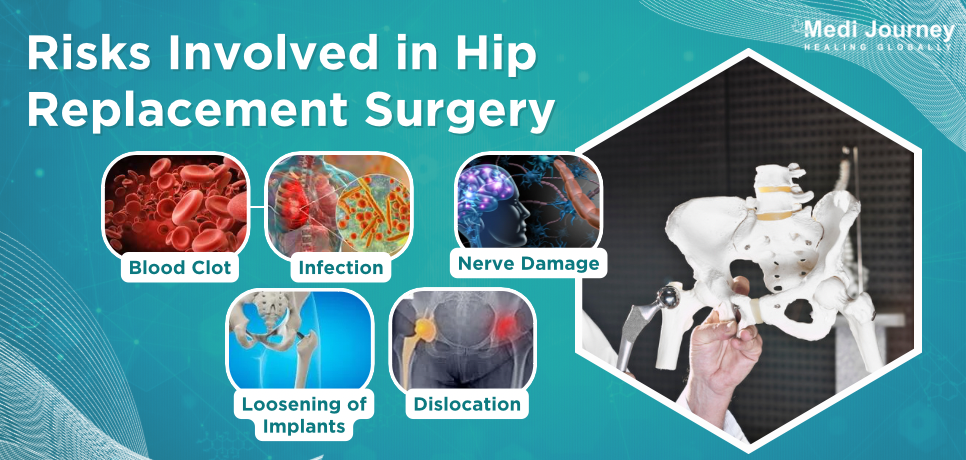 Hip Replacement Surgery Risks